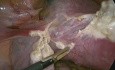 Histerectomía laparoscópica total en caso de embarazo ectópico con cicatriz