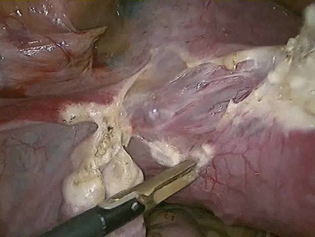 Histerectomía laparoscópica total en caso de embarazo ectópico con cicatriz