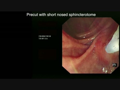 CPRE de Neoplasia Mucinosa Papilar Intraductal