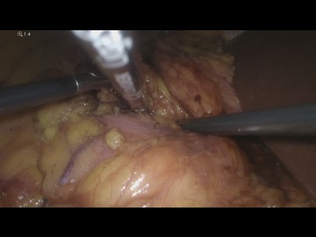 Suprarrenalectomía derecha laparoscópica y tumorectomía renal derecha simultáneas