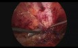 Reparación laparoscópica E-Tep Rives Stoppa de hernia múltiple