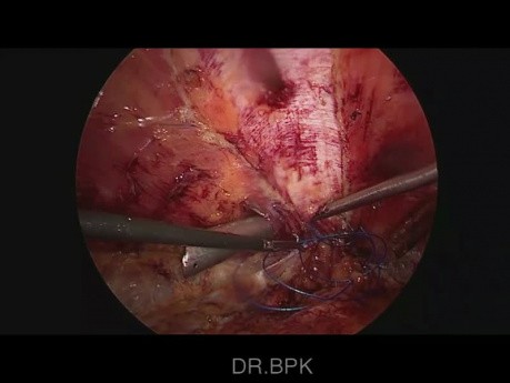 Reparación laparoscópica E-Tep Rives Stoppa de hernia múltiple