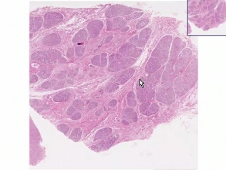 Hiperplasia del tejido mamario durante el embarazo - histopatología mamaria