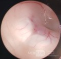 Tercera ventriculostomía endoscópica en un caso benigno de síndrome de Aicardi con hidrocefalia obstructiva y malformación de Chiari tipo 1