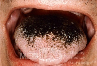 Lengua peluda negra