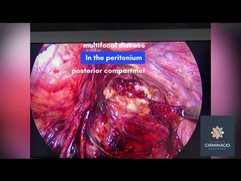 Endometriosis and infertility 