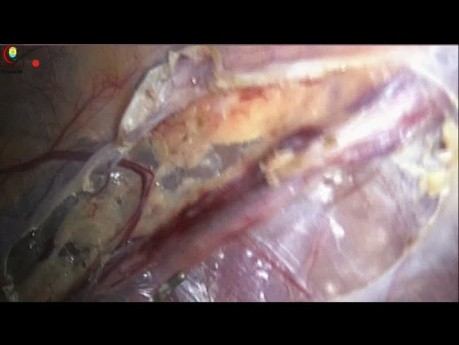 ¿Cómo diseccionar para varicocelectomía laparoscópica con preservación arterial?