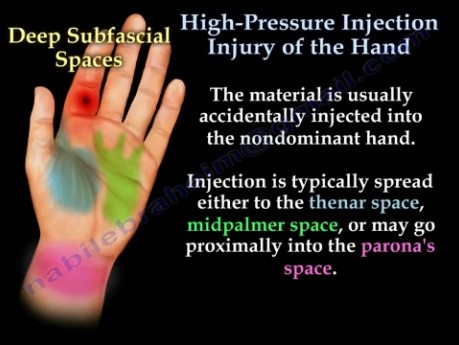 Lesiones por inyección de alta presión