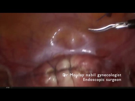 Polimiomectomía laparoscópica rápida segura