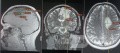 Planificación quirúrgica con neuronavegador en paciente con lesión de masa intracraneal. Glioma de alto grado.