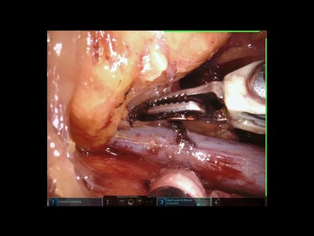 Gran tumor mediastínico