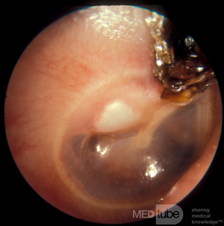 Costra ática y colesteatoma
