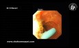 Extracción endoscópica de stent biliar