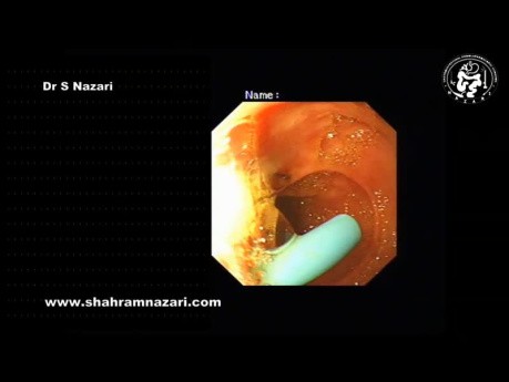 Extracción endoscópica de stent biliar
