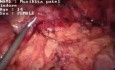 Apendicectomía laparoscópica - mujer de 19 años