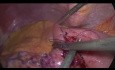 Conversión de Bypass gástrico de una anastomosis a Bypass gástrico en Y de Roux