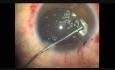 Implante de traumatismo ocular cerrado, vitrectomía anterior Pars Plana, faco, ATC e implante de LIO