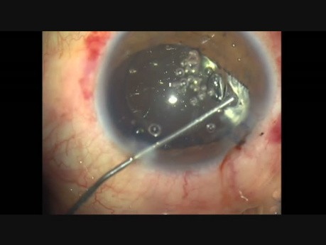 Implante de traumatismo ocular cerrado, vitrectomía anterior Pars Plana, faco, ATC e implante de LIO