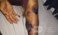 Identificación de lesiones