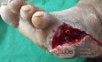 Amputación del quinto dedo del pie diabético