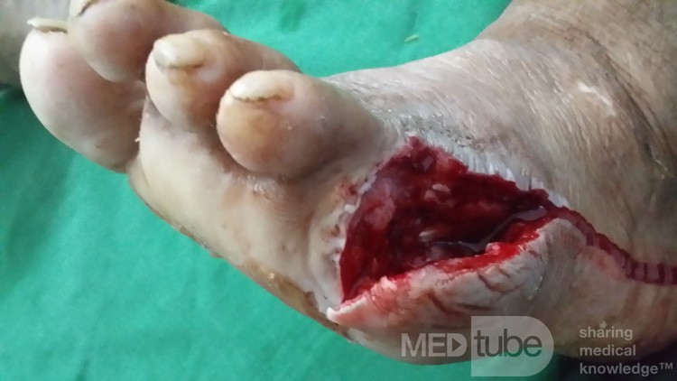 Amputación del quinto dedo del pie diabético