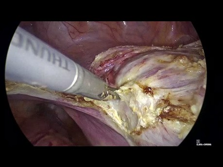 Histerectomía total laparoscópica - ¿importa el tamaño?