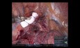Segmentectomía robótica derecha S1 (sin editar)