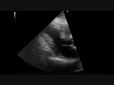 Arteriopatía Coronaria. Ecografía de esfuerzo durante el Ejercicio y Angiografía Coronaria