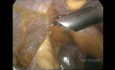 Colecistectomía laparoscópica en paciente con antecedente de cirugía hepática abierta previa