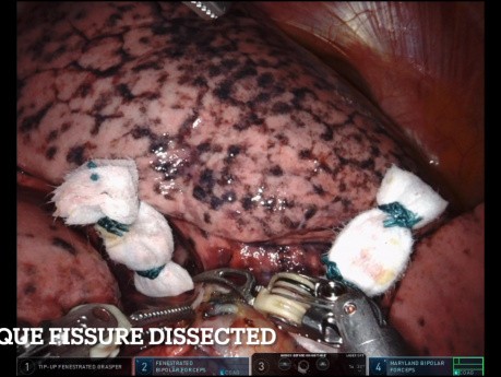 Segmentectomía pulmonar S8+9 del lóbulo inferior derecho