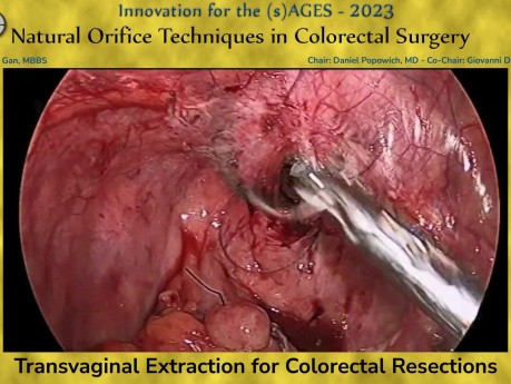 Extracción transvaginal para resecciones colorrectales