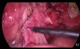 Cirugía Laparoscópica de Emergencia para Diverticulitis Aguda - Hartmann