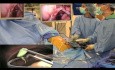 Formación de residentes con colecistectomía laparoendoscópica de sitio único (LESS) con anestesia epidural