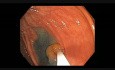 Colonoscopia - cómo realizar RME - lesión B 