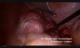 Cómo ignorar las indicaciones de la miomectomía laparoscópica: consejos y trucos
