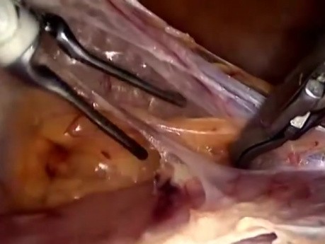 Histerectomía laparoscópica total - técnica estándar