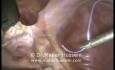 Banda gástrica - abordaje laparoscópico