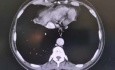 Reseccion Laparoscopica De Cancer En Anastomosis Ileo Rectal Posterior A Colectomia Total