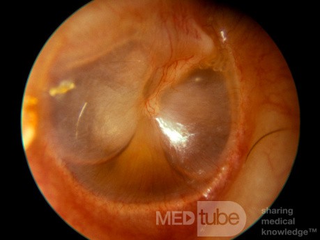 Nivel hidroaéreo de otitis media serosa [oído derecho]