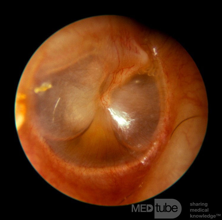 Nivel hidroaéreo de otitis media serosa [oído derecho]