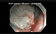Colonoscopia - RME de pólipo serrado en colon transversal