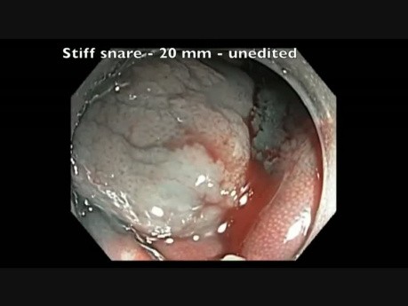 Colonoscopia - RME de pólipo serrado en colon transversal