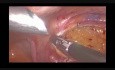 Hemicolectomía derecha laparoscópica radical con disección del ganglio linfático D3 y anastomosis intracorpórea para el cáncer de cecum: cómo lo hago