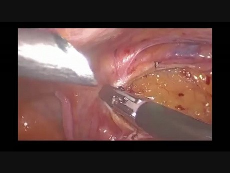 Hemicolectomía derecha laparoscópica radical con disección del ganglio linfático D3 y anastomosis intracorpórea para el cáncer de cecum: cómo lo hago