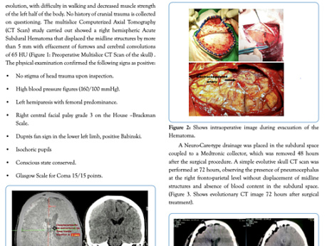 Acute Spontaneous Cerebral Hemorrhage in the Subdural Space Clinical case.pdf