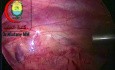 Hernia congénita derecha laparoscópica de un niño de 4 años