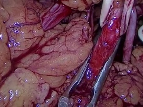 Nefrectomía parcial laparoscópica