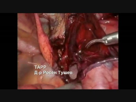 Reparación de hernia inguinal derecha - TAPP