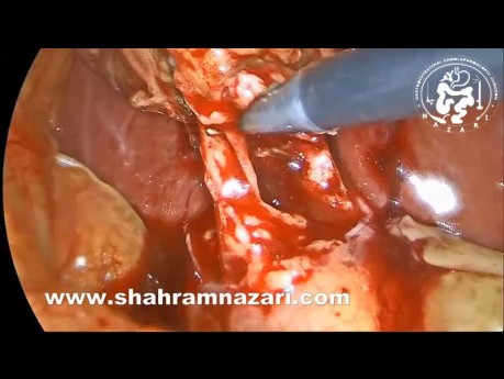 Colecistostomía laparoscópica en la colecistitis gangrenosa aguda