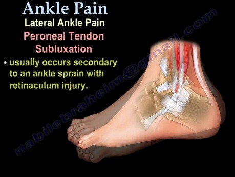 Dolor de tobillo - ligamentos, esguince - video-clase